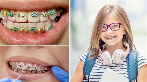 que es mejor los brackets esteticos o metalicos|brackets de cerámica.